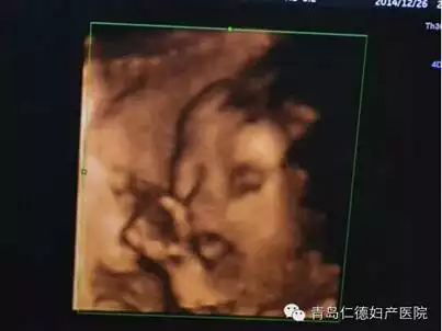 1、这是我怀孕24周时拍的四维B超图，这个图是不是拍到了男孩的