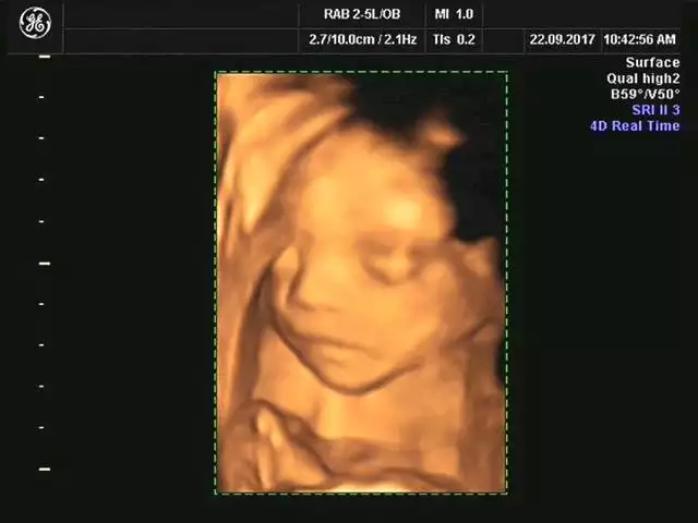 生儿子的四维彩超图片：3个不同阶段的b超图,都有信息告诉你!宝宝是是女宝!