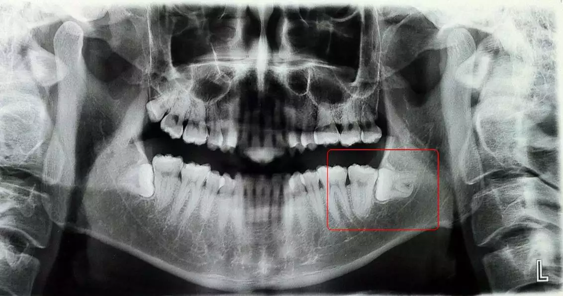 5、长智齿预示着什么运势:长智齿代表什么运势
