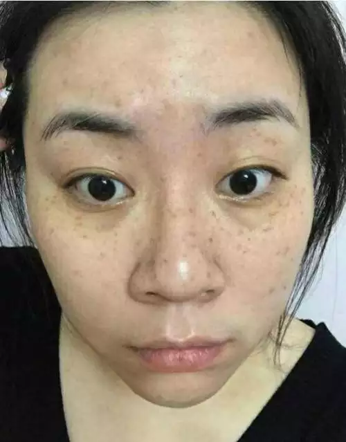 1、女人脸上长斑是怎么造成的:女人脸上长斑是什么原因 什么年龄段的人易引起斑