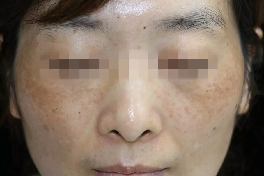 3、女人脸上长斑是怎么造成的:女人脸上长斑是什么原因