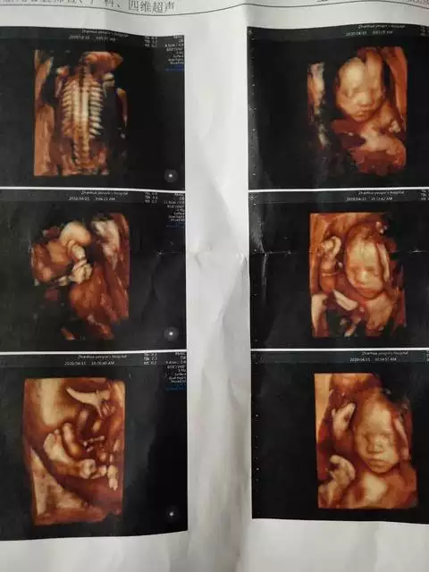 1、四维彩超男孩特征图片:6个月胎儿四维彩超图从那些可看出是男孩?