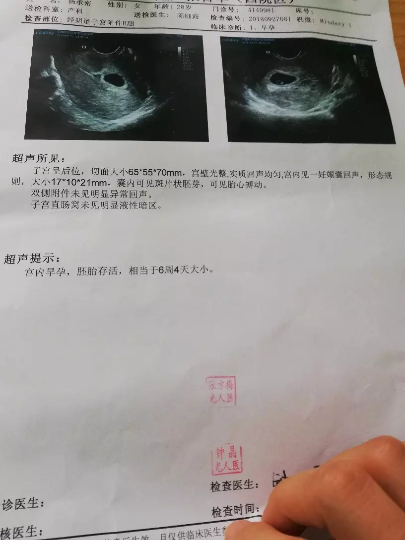 3、怀孕49天时,孕囊大小是24×23×17,看这三个数据,是还是女宝?