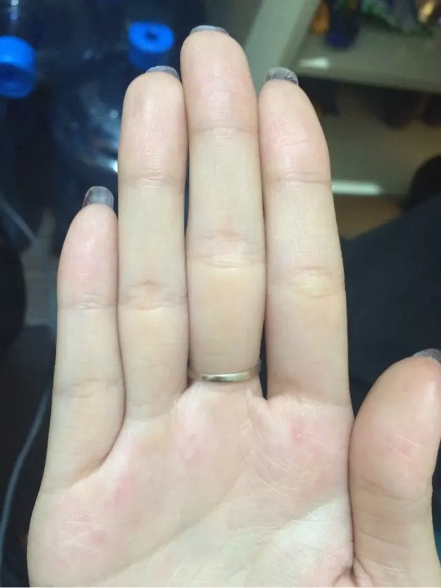 2、手指头肉多运势:手指的人命运怎样