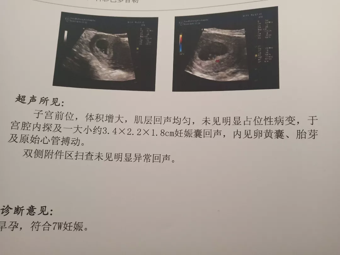 长孕囊和圆孕囊的区别图片：看早期孕囊形状看男女准吗?