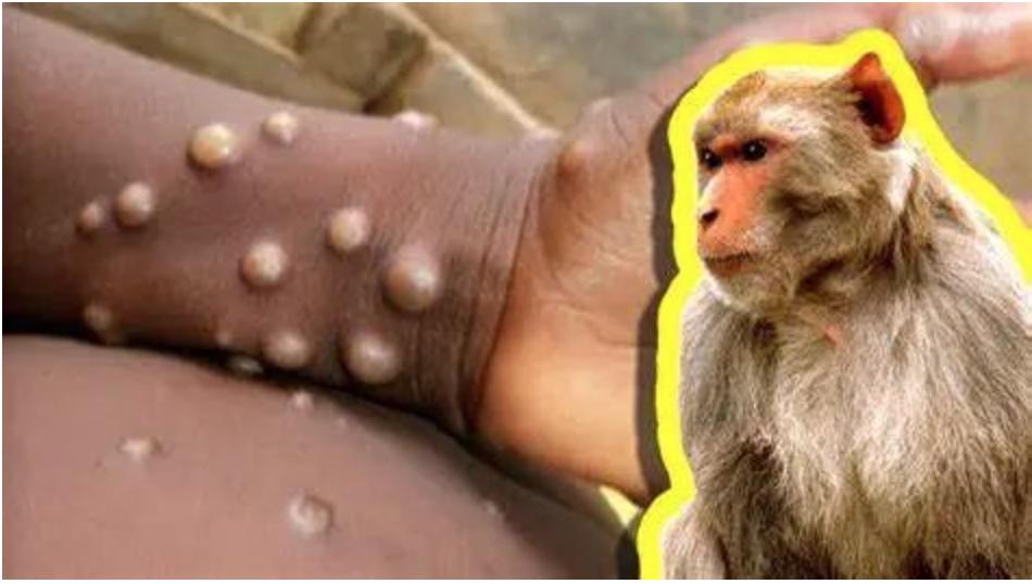 11国80例猴痘患者，我国尚未出现，专家：加强人物检疫