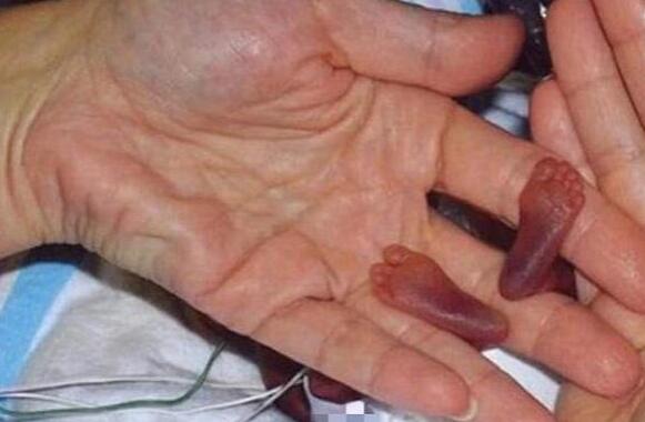 世界上最小的婴儿是谁，阿米利娅·泰勒(不到300克)