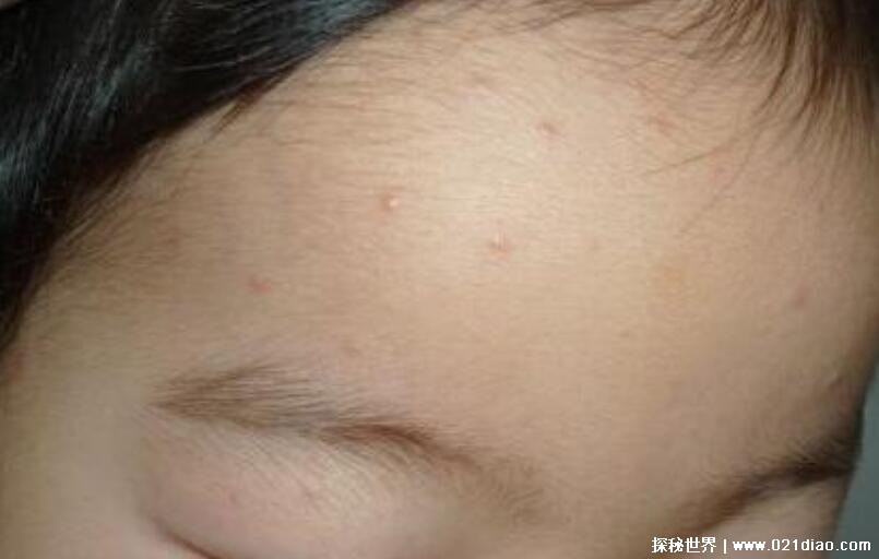 水痘的7天演变过程图片，会对人体免疫系统造成非常严重打击