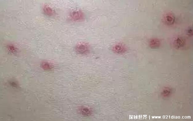 水痘的7天演变过程图片，会对人体免疫系统造成非常严重打击
