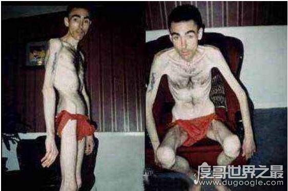 世界上最瘦的男人，费瑞尔·季利兹(患厌食症仅重80斤)